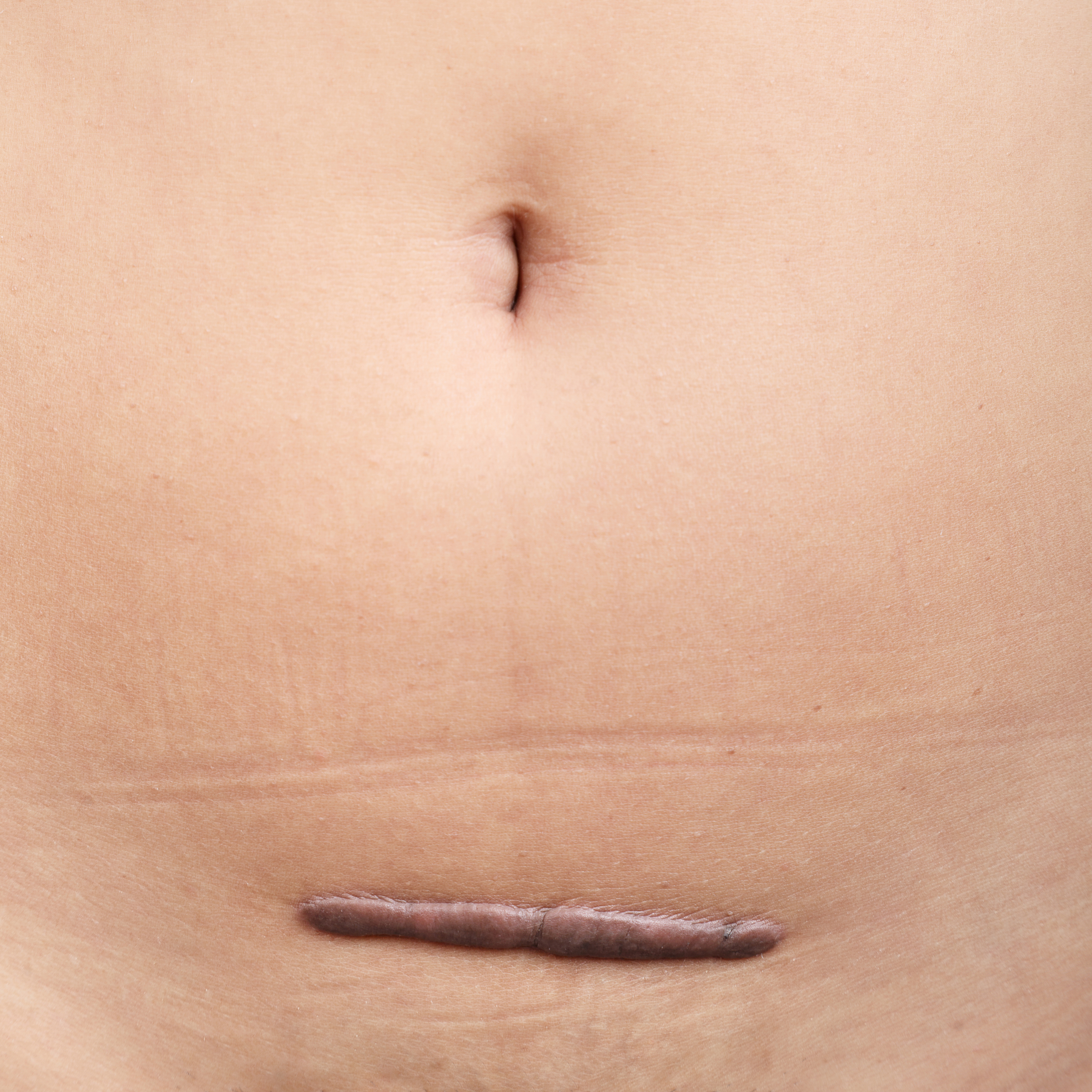 C-section scar therapy